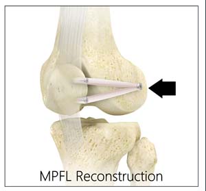 Medial Patellofemoral Knee Reconstruction