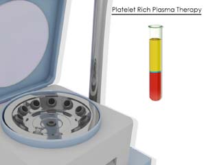 Platelet Rich Plasma