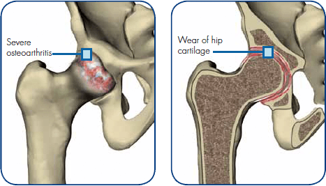 Minimally Invasive Revision THR - Anterior Approach