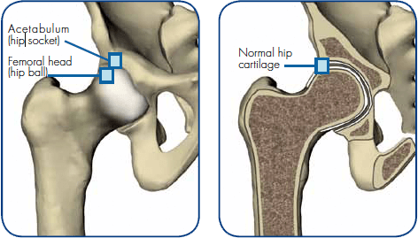 Minimally Invasive Revision THR - Anterior Approach